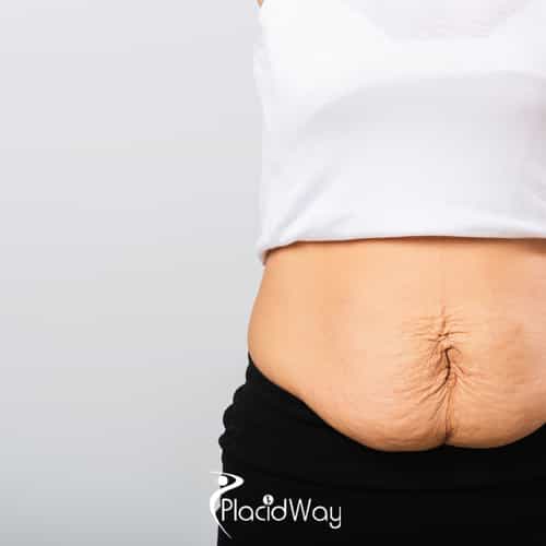 Tummy Tuck in Mexico vs USA - How American Moms Are Avoiding $12,000 Surgical Bills